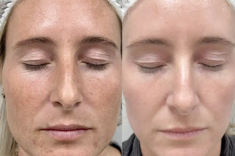 alpha ipl pigmentvlekken voor en na